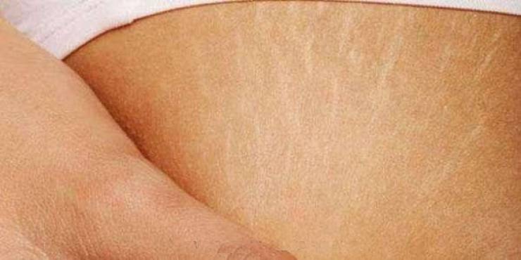 تخلصي من تشققات البطن ب 4 خطوات فقط!