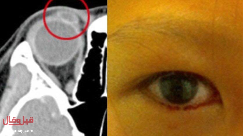 فتاة عمرها ١١ سنة وتذرف بدل الدمع دماً من عينها! إليكم السبب