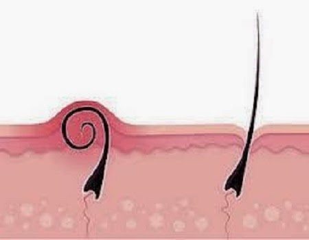 4 طرق سهلة للتخلص نهائياً من الشعر تحت الجلد..