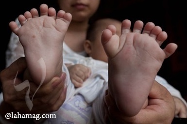 بالصور – أغرب ولادة.. طفل بـ 31 إصبعاً!
