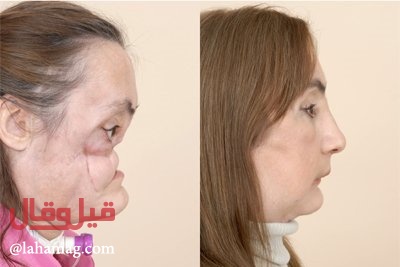 بالصور – زراعة وجه كامل لامرأة اطلق زوجها الرصاص عليه.. شاهدوها