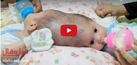 بالفيديو - لن تصدقوا ما ستشاهدونه من التصاق رأسي هذين التوأمين