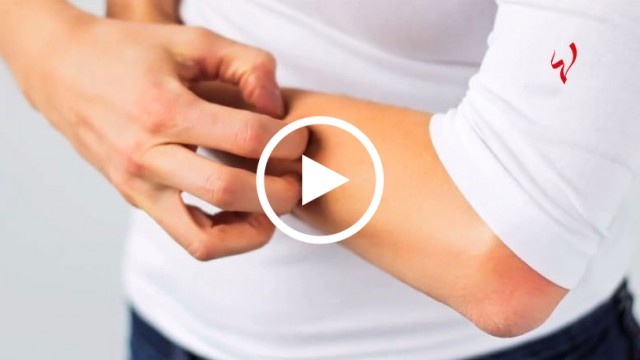 صحتك مع كارين - هكذا قد تظهر حساسيتك الجلدية فجأة