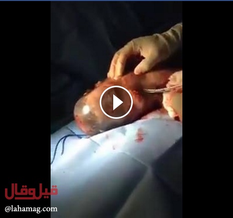 بالفيديو- جنين لا يزال داخل الكيس المحيط به بعد خروجه من بطن والدته!