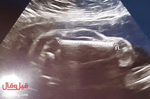 بالصورة - امرأة حامل بجنين بهيكل سيارة رياضية! إليكم تفاصيل المعجزة!