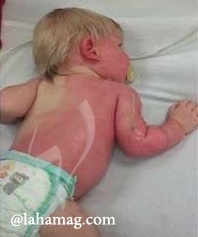 بالصور – أم تحرق جسد طفلها بالماء الساخن!!