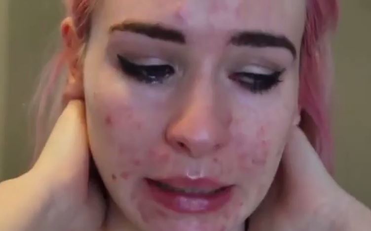 بالفيديو - فتاة تعالج حب الشباب.. لا تفوّتوا ماذا حصل!