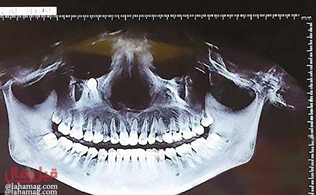 بالصور - شاهدوا أغرب حالة.. نمو سن أسفل عين إمرأة!