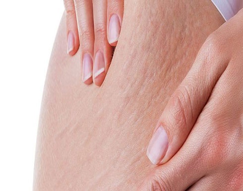 تخلّصي من علامات تمدّد البشرة في أسبوعين.. إليك الخلطة السحرية!!