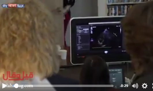 بالفيديو- صوت قلبه يكفيني... سمعت دقّات قلب ابنها بعد 3 سنوات من وفاته!!