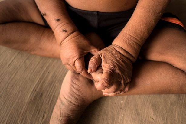 بالفيديو والصور - طفل يعاني من حالة نادرة تجعله بجسم عجوز.. إليكم القصة!