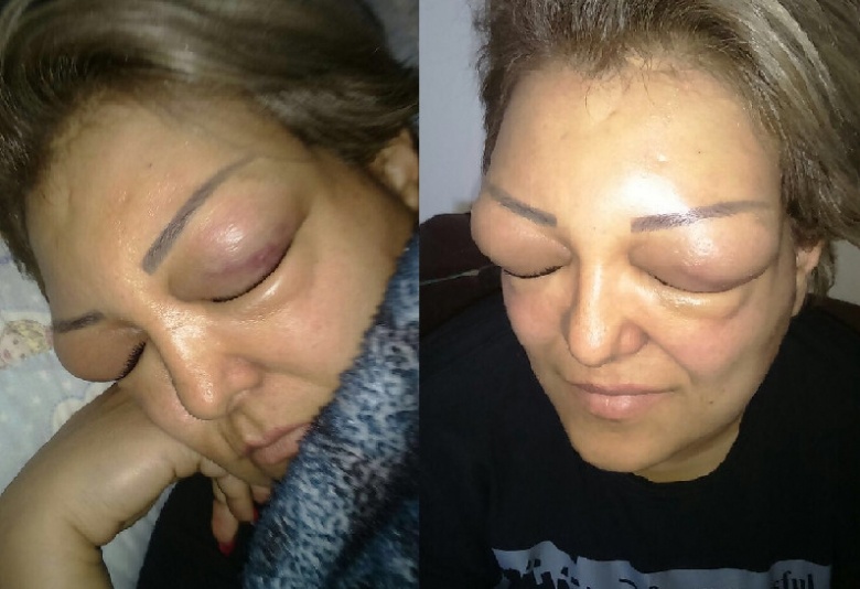 بالصور - لبنانية تفقد بصرها بسبب حقنة بوتوكس!