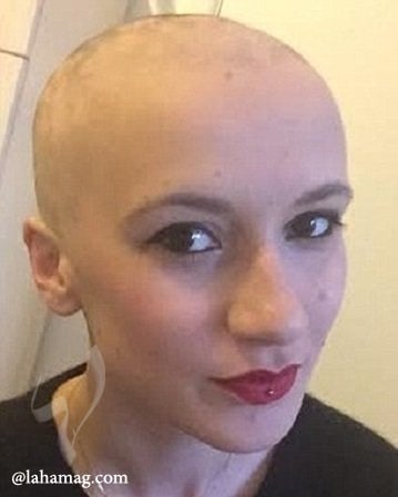 بالصور - شابة تصاب بالصلع لسبب نادر..