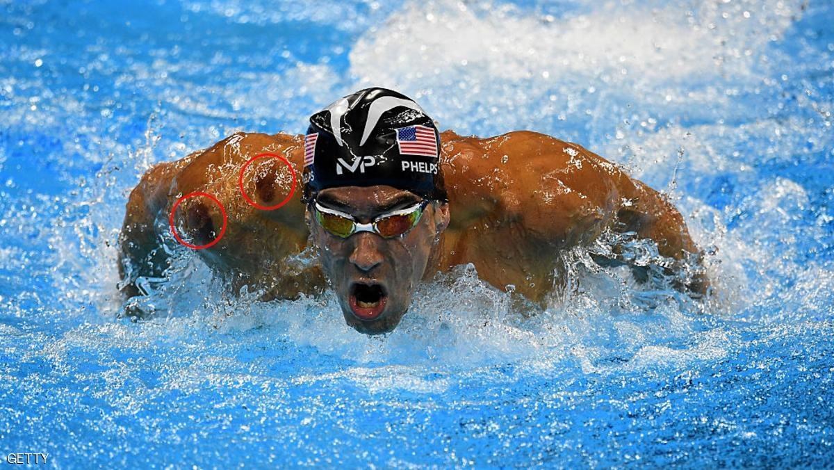 هل تساءلتم يوماً لم أجسام أبطال الأولمبياد مبقعة بالأحمر؟! إليكم السبب!!