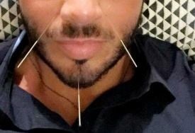 لأصحاب القلوب القوية... صورة مذيع لبناني خلال وخز وجهه بالأبر