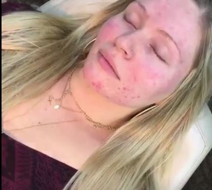 بالفيديو - هكذا تتخلصين من البثور واحمرار الوجه