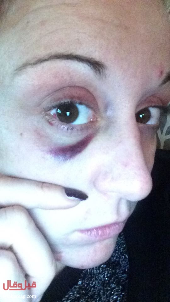 بالصور - ضربت امرأة حامل بسبب تعليق على فايسبوك!