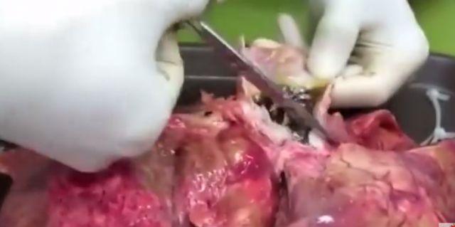 فيديو صادم - شاهدوا ماذا يحدث للرئتين بعد تدخين 20 سيجارة!!