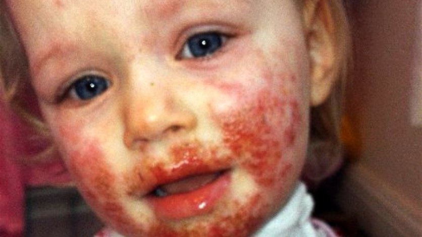 صور صادمة - أصبحت هكذا بسبب قبلة من قريبتها... اليكم التفاصيل لتحذروا وشاهدوا كيف أصبحت الأن!