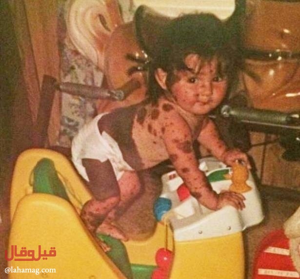 بالصور - ولدت بمئات الوحمات على كامل جسدها.. شاهدوا كيف أصبحت بعد 20عاماً!