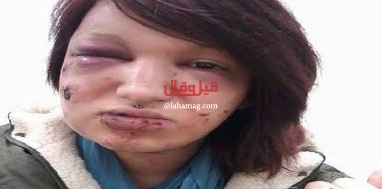 شاب يشوه صديقته بقضمها 21 مرة في وجهها لسبب غريب.. اليكم القصة!!