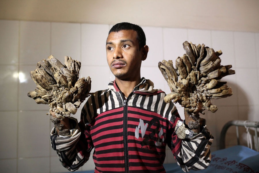 يُعرف بالرجل الشجرة.. لن تصدقوا كيف تنمو الأغصان على يديه وهذا ما حدث له أخيراً