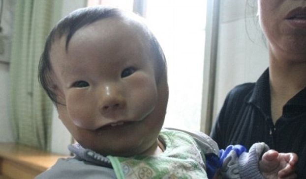 الطفل «ذو الوجهين» يثير حيرة الأطباء