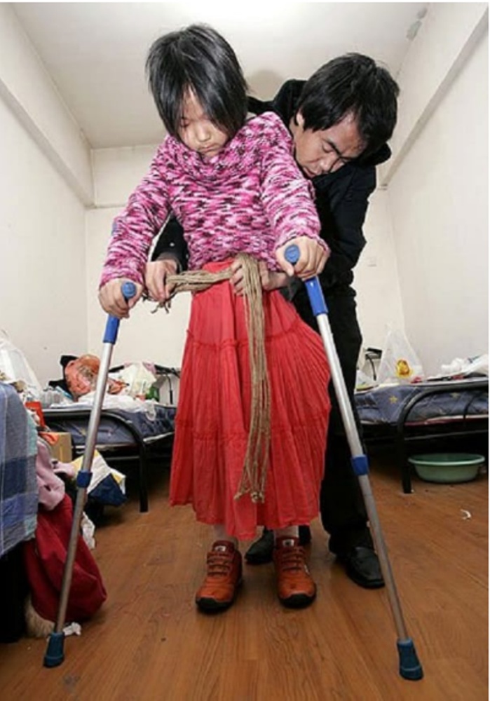 مؤثر جداً - بُتر جزؤها الأسفل فاستعانت بكرة سلة.. إليكم القصّة المدهشة لبطلة عالمية!