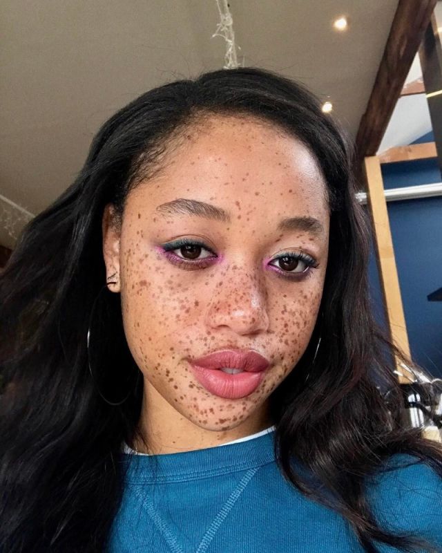 سخروا منها وشبّهوا وجهها بالموز... فردّت بصورة غيّرت حياتها!