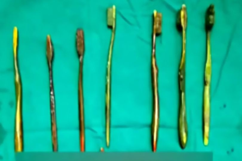 بالصور - استخراج 7 فراشي أسنان من معدة شابة.. إليكم القصة