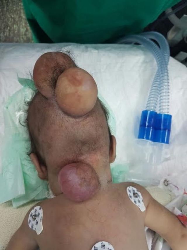في السعودية - إنقاذ طفل من الموت بجراحة نادرة في المخ.. اليكم ما حصل!؟