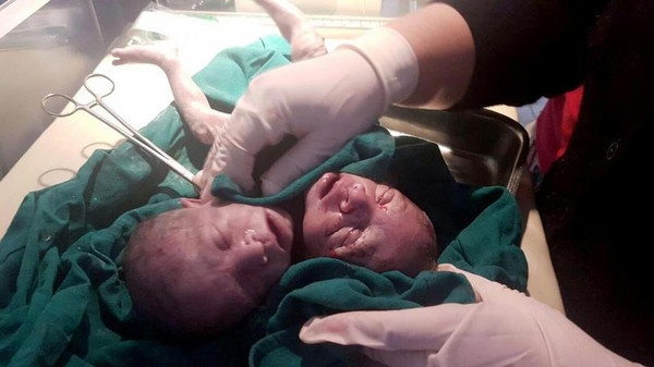 بالصور - مولود بجسد واحد ورأسين.. وهذا مصيره بعد ساعات على الولادة!
