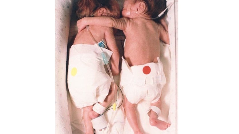 الصورة التي شغلت الملايين - رضيعة تعانق توأمها المريض... ماذا حصل بعد 22 عاماً؟