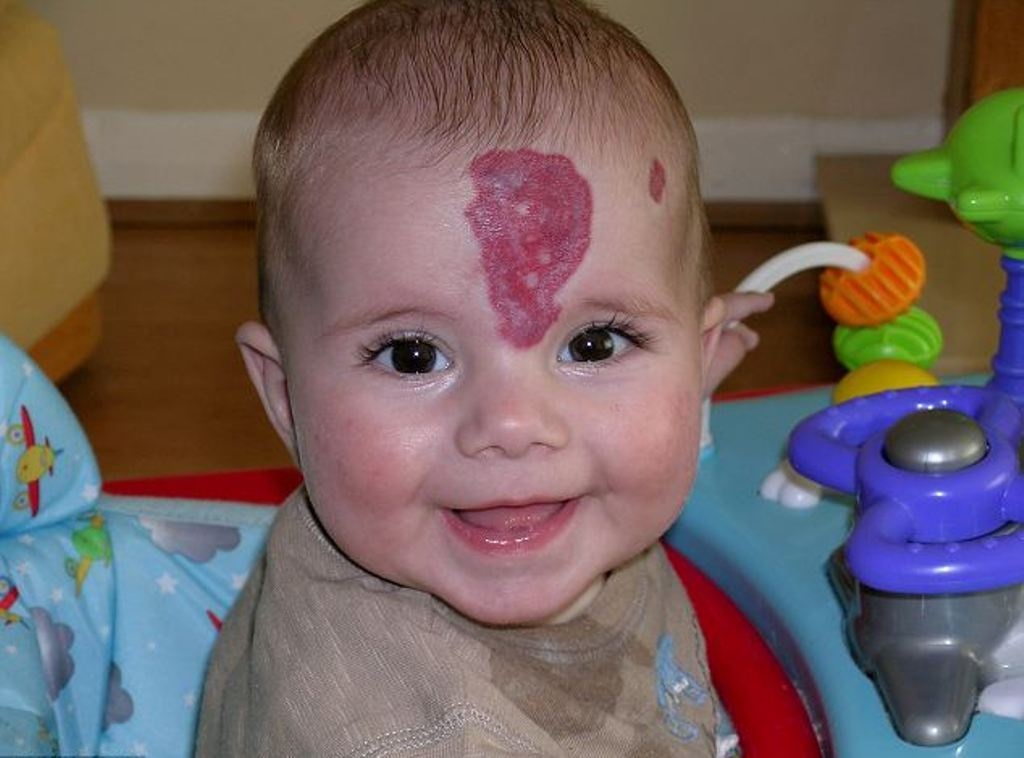 سخروا منه بسبب بقعة و«قرنين» على جبينه... إليكم كيف تغيّر شكل هذا الطفل اليوم