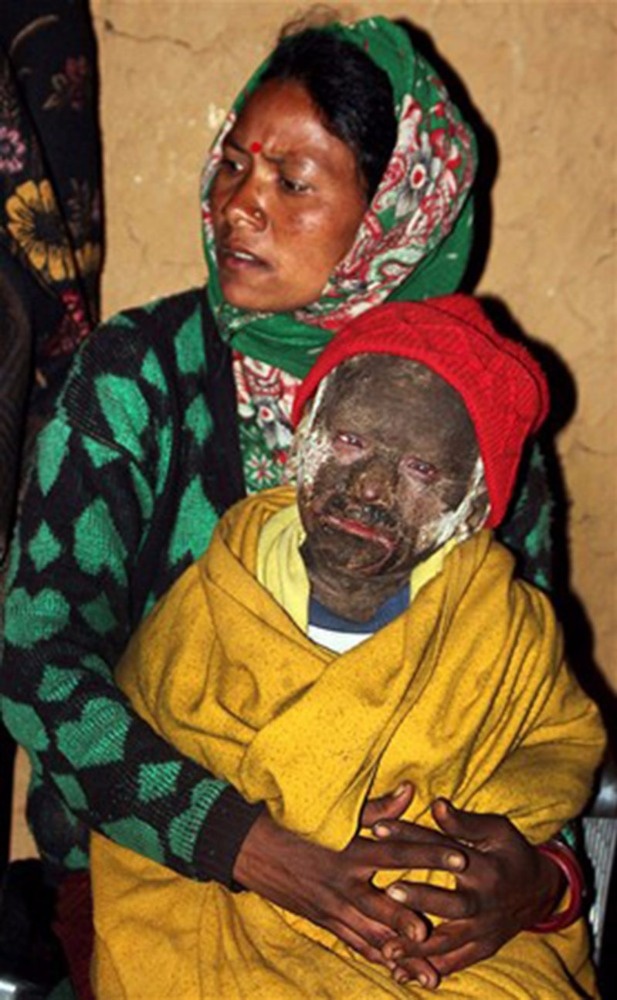 لن تصدّقوا- صبي يتحوّل إلى حجر بسبب مرض نادر... اكتشفوا ما حدث له!