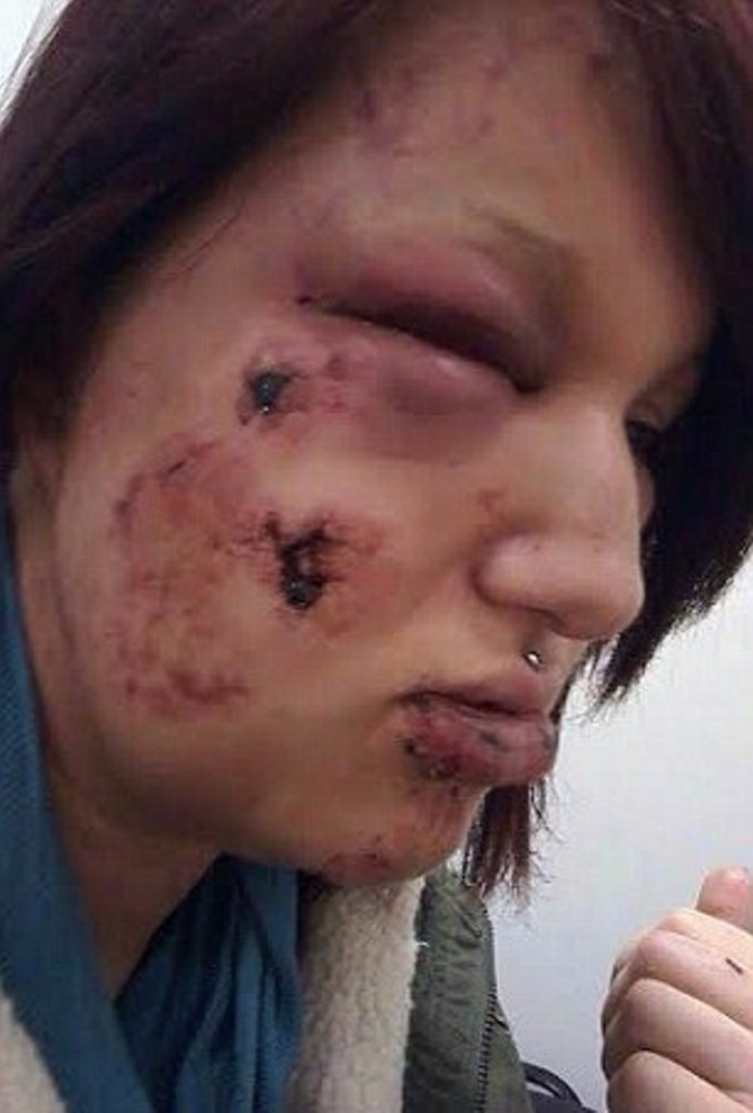 عضّ وجه صديقته السابقة 21 مرة... وما قاله عن السبب لا يُصدّق