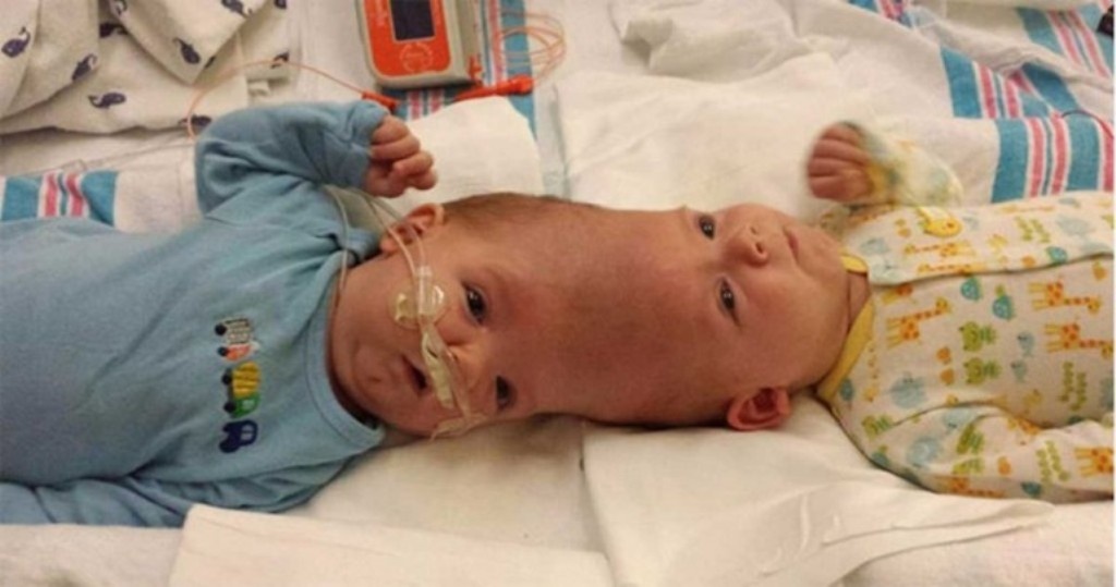 حالة نادرة - ولدا برأسين متلاصقين... شاهدوا كيف أصبح هذان التوأمان بعد فصلهما