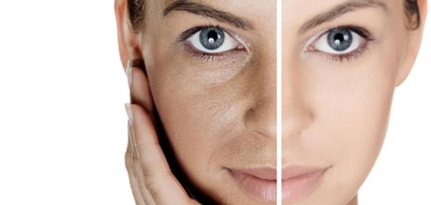 وصفة منزلية رائعة لعلاج الكلف في دقائق.. إليك السر