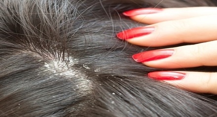 خلطة منزلية للتخلص من قشرة الشعر في أسبوع.. إليك الطريقة