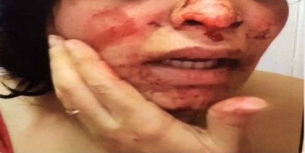 هذه الصور لسعوديات معنفات... هذه تفاصيل القضية