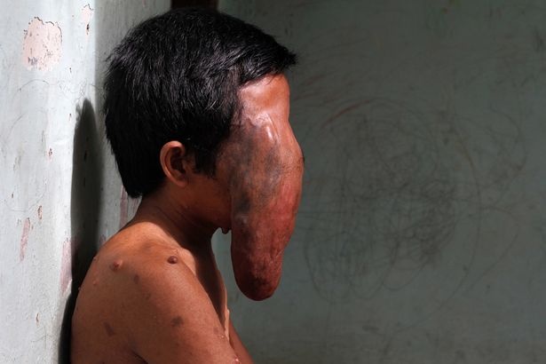 بالفيديو - مرض عجيب جعل هذا الرجل مثل الفيل!