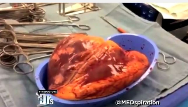 بالفيديو - لقطات صادمة لقلب تحت تأثير المخدرات!!