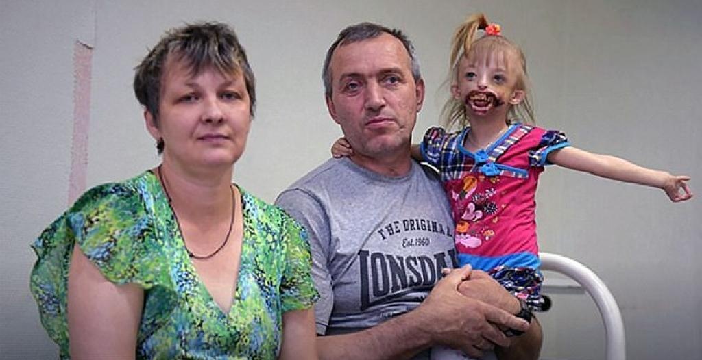 ولدت من دون ذقن وشفاه... هكذا واجهت هذه الطفلة الروسية قسوة الأقارب ورفض دور الأيتام