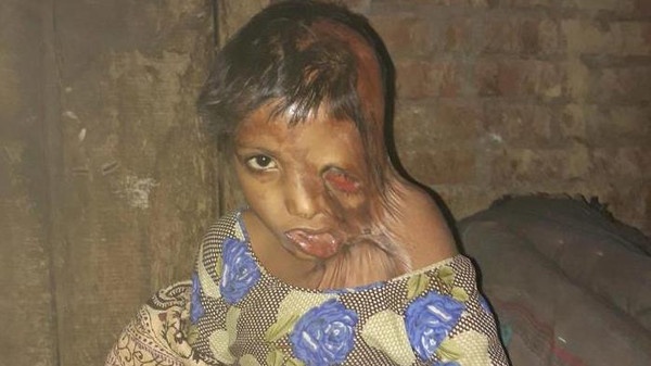 بالصور (18+) - طفلة ذاب وجهها بسبب والديها! لن تصدقوا مأساتها!