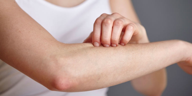 هذا ما يجب أن تضعوه على مناطق لسع الحشرات لتمنعوا الحكاك... الوصفة سهلة جداً