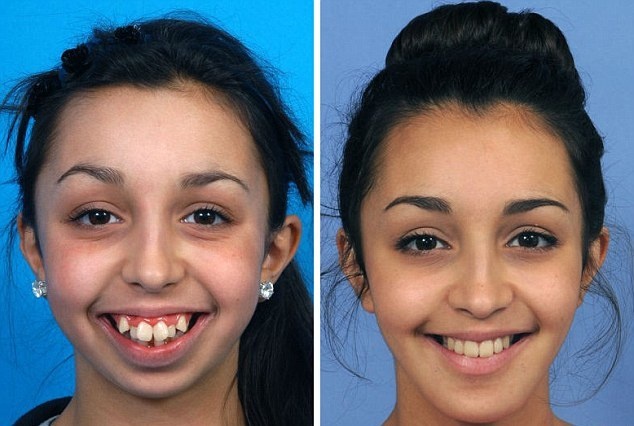 بالصور - بعدما عانت 20 عاماً من تشوه في الفك.. لن تصدقوا كيف أصبح شكلها بعد العملية!!