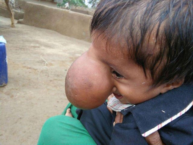 صور وفيديو مؤثرة جداً- كبر أنفه وأصبح أكبر من حجم كرة التنيس...  مأساة هذا الطفل ستبكيكم