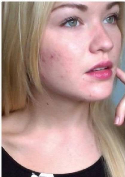 تحدت الساخرين منها واستخدمت هذه الوصفة للقضاء على حب الشباب والبثور.. والنتيجة مذهلة!!