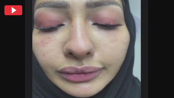 بالفيديو - خبيرة تجميل سعودية تدمر وجهها بإبر التجميل.. شاهدوا تجربتها الصادمة!
