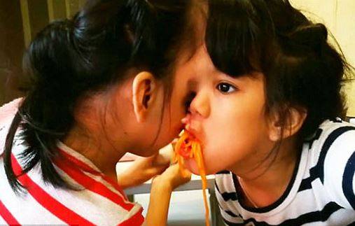 صور مؤثرة - في حالة نادرة.. إلتصاق توأم بطريقة غريبة في الرأس!